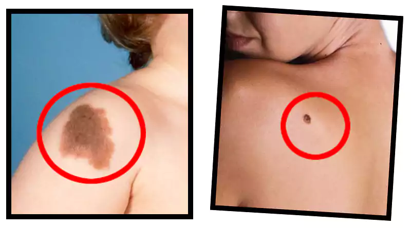 Moles in unwanted places on the body?